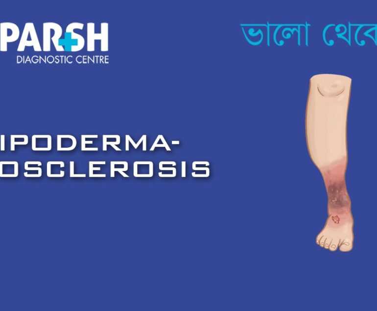 Lipodermatosclerosis