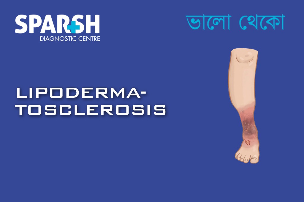 Lipodermatosclerosis