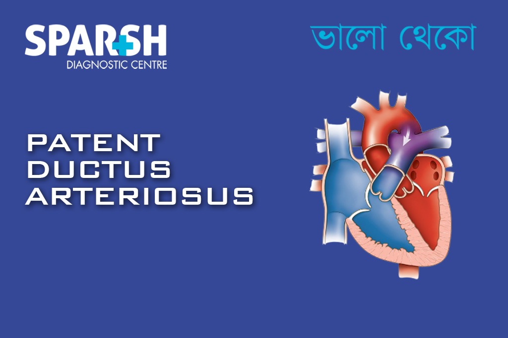 Patent Ductus Arteriosus PDA