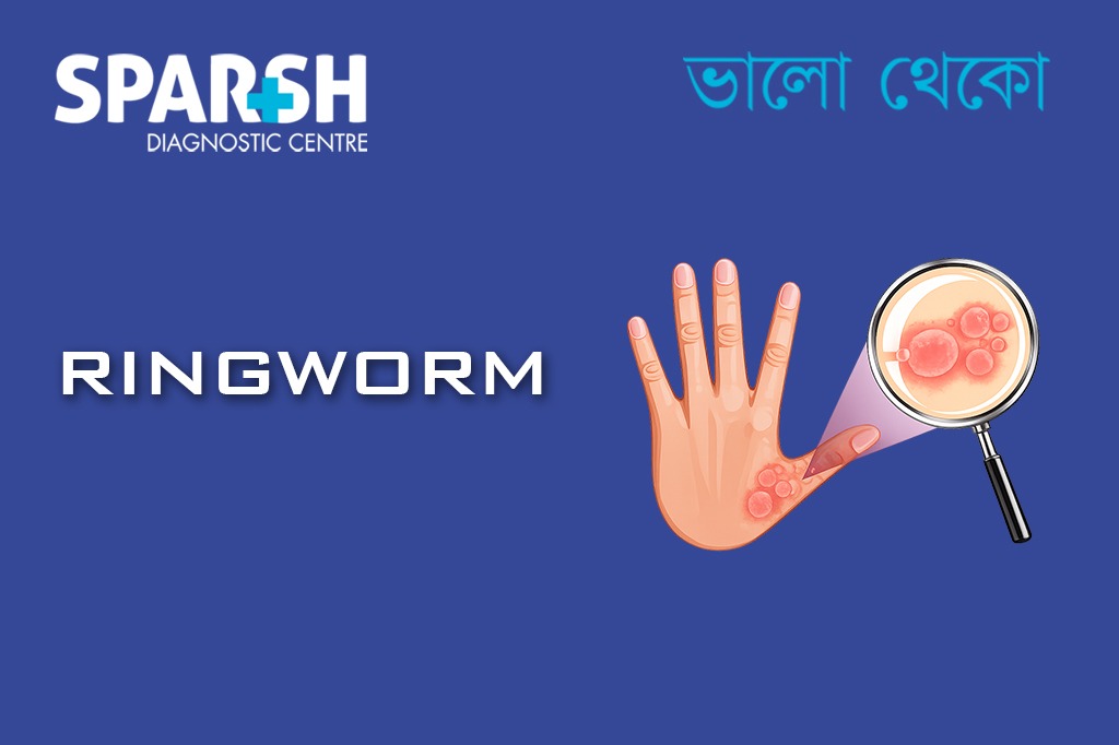 Ringworm