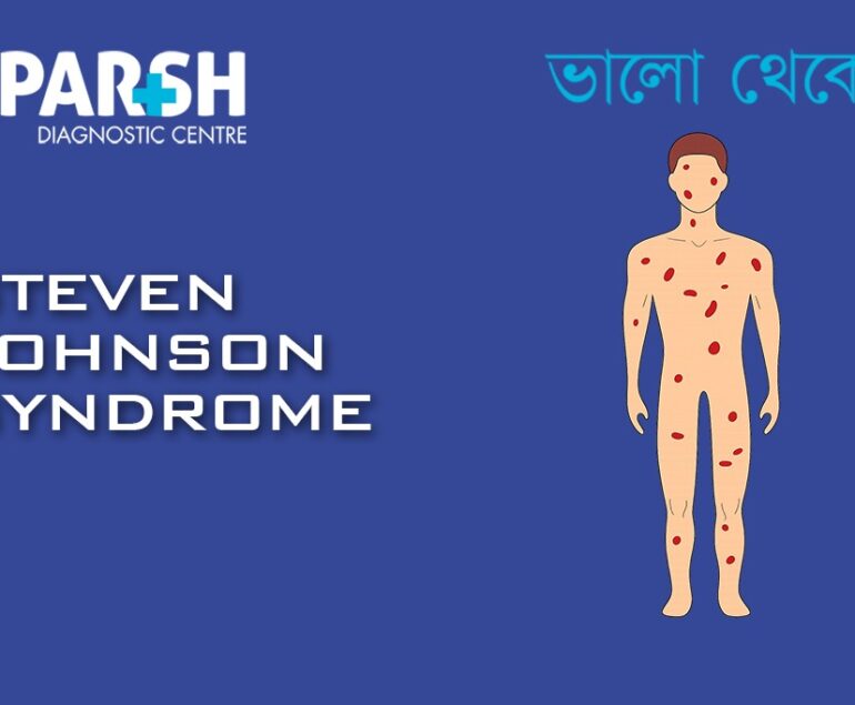 Steven Johnson Syndrome