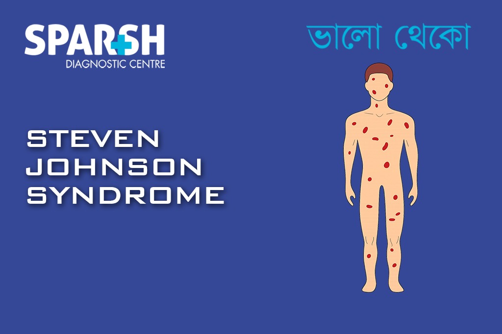 Steven Johnson Syndrome